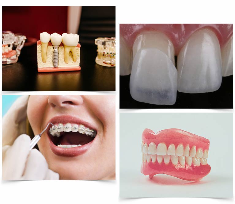 Invisalign, Arte Oral Odontologia Especializada